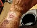 Skóra na nadgarstku jest zaczerwieniona i podrażniona, co może być wynikiem odparzeń od zegarka Garmin.