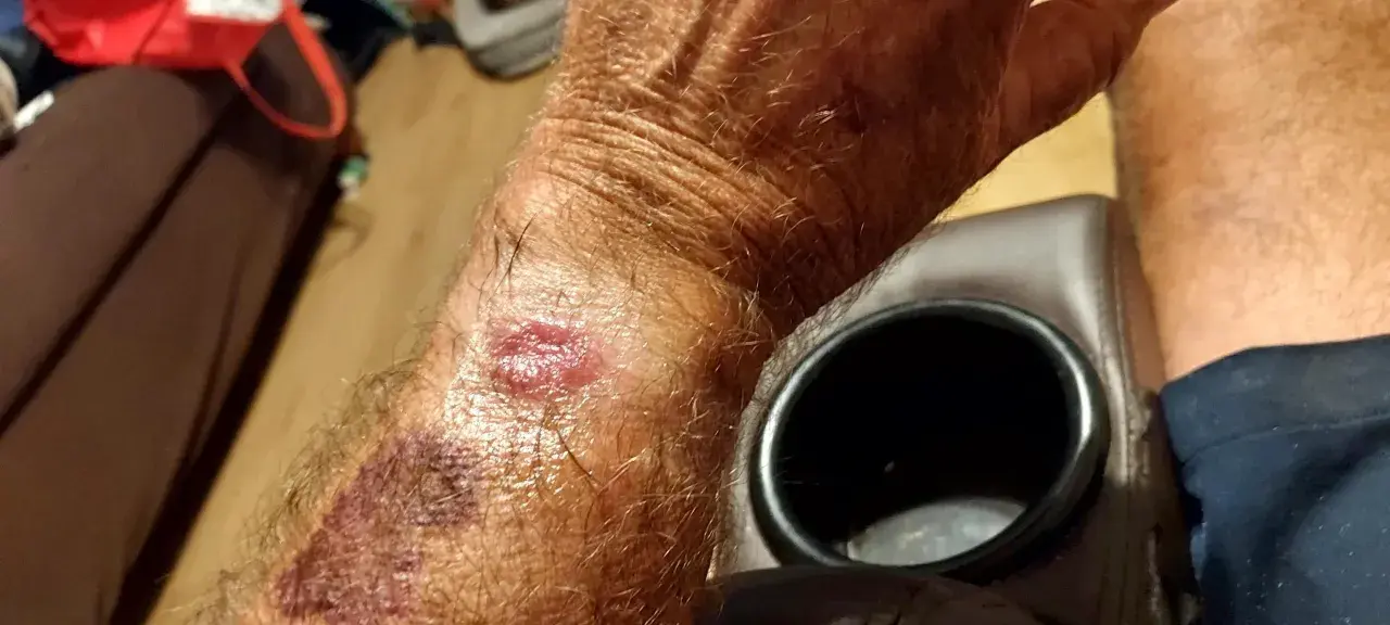 Skóra na nadgarstku jest zaczerwieniona i podrażniona, co może być wynikiem odparzeń od zegarka Garmin.