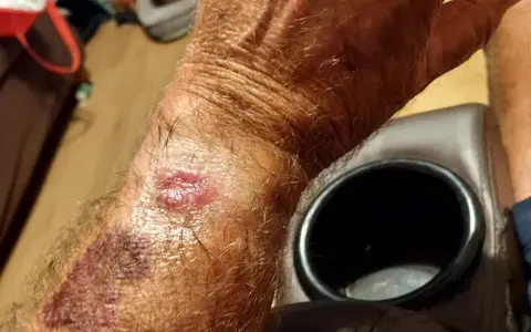 Skóra na nadgarstku jest zaczerwieniona i podrażniona, co może być wynikiem odparzeń od zegarka Garmin.
