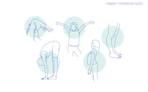 Ilustracje pokazujące objawy hipermobilności: zginanie palców, skłon do przodu, rozciąganie ramion, wygięcie pleców i staw skokowy.