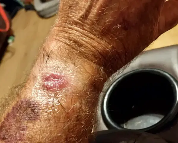 Skóra na nadgarstku jest zaczerwieniona i podrażniona, co może być wynikiem odparzeń od zegarka Garmin.