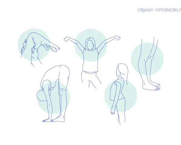 Ilustracje pokazujące objawy hipermobilności: zginanie palców, skłon do przodu, rozciąganie ramion, wygięcie pleców i staw skokowy.