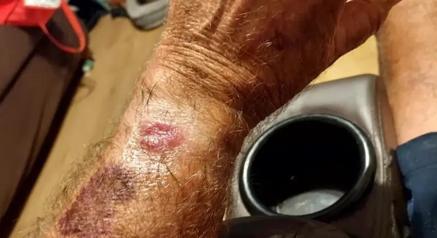Skóra na nadgarstku jest zaczerwieniona i podrażniona, co może być wynikiem odparzeń od zegarka Garmin.