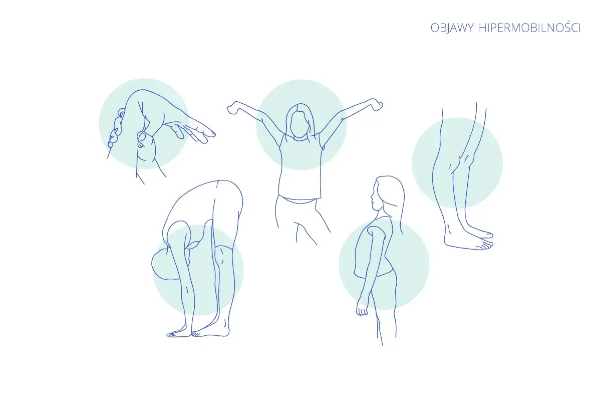 Ilustracje pokazujące objawy hipermobilności: wygięcie palca, skłon do przodu, rozciąganie ramion, wygięcie plec&oacute;w i nienaturalne ułożenie st&oacute;p.